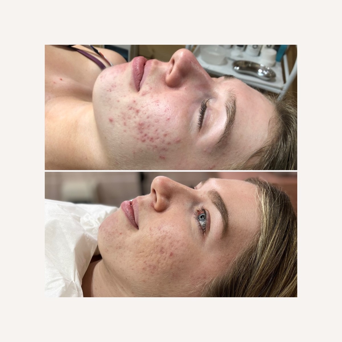 Real LA Skin Spa client result 1, shown without retouching
