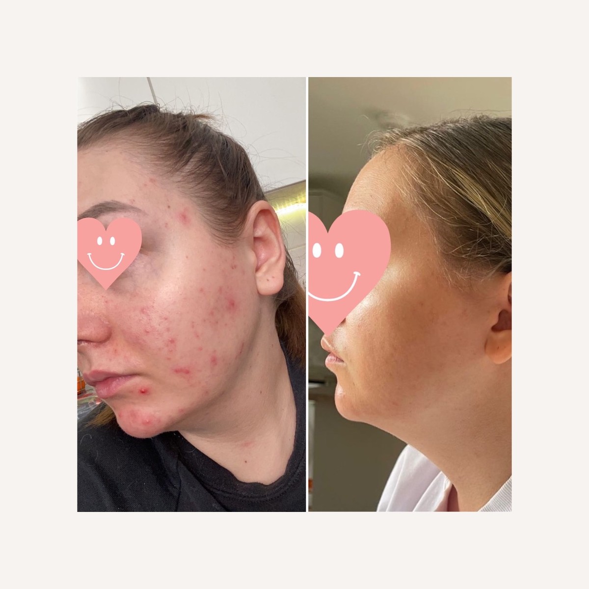 Real LA Skin Spa client result 2, shown without retouching