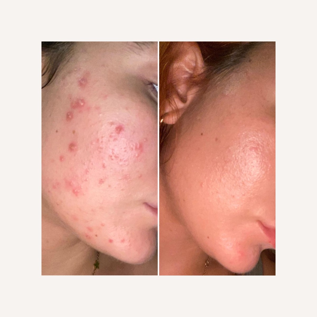 Real LA Skin Spa client result 3, shown without retouching