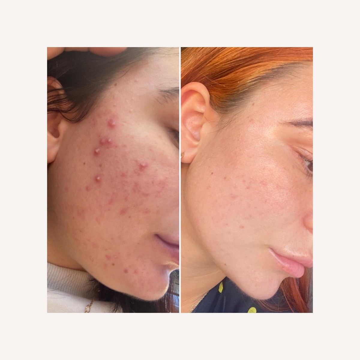 Real LA Skin Spa client result 4, shown without retouching