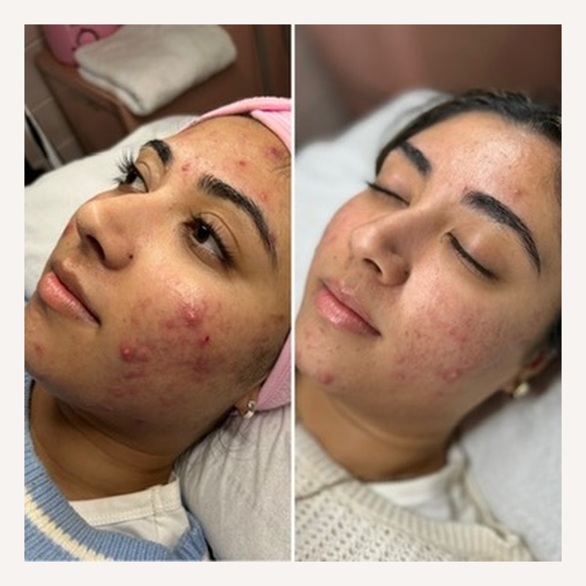 Real LA Skin Spa client result 5, shown without retouching