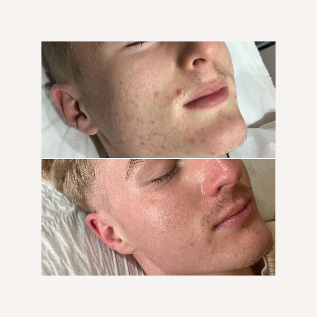 Real LA Skin Spa client result 6, shown without retouching