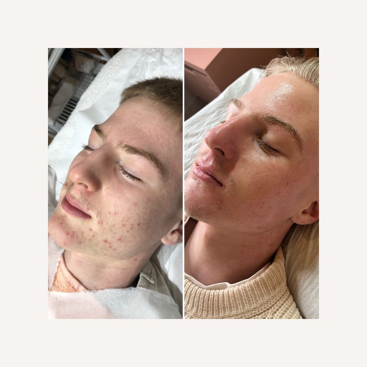 Real LA Skin Spa client result 7, shown without retouching