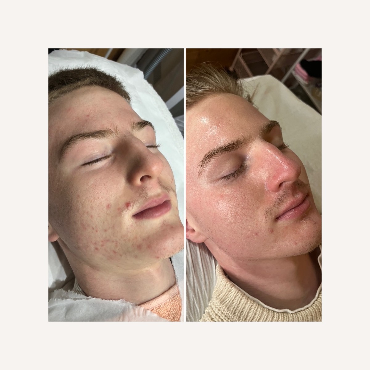 Real LA Skin Spa client result 8, shown without retouching