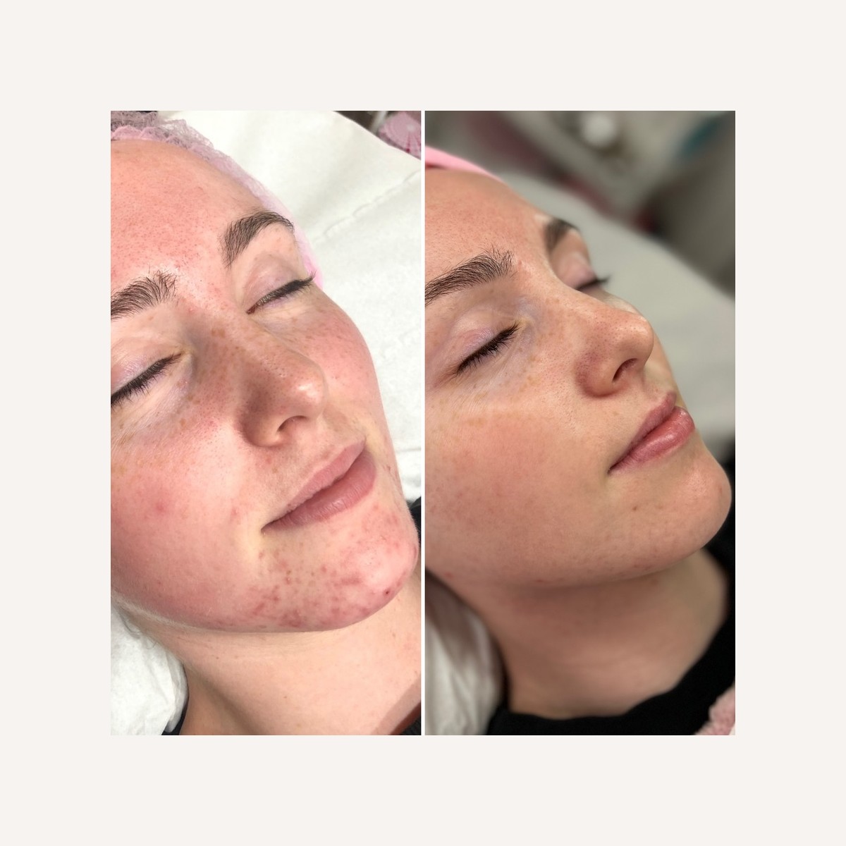 Real LA Skin Spa client result 9, shown without retouching
