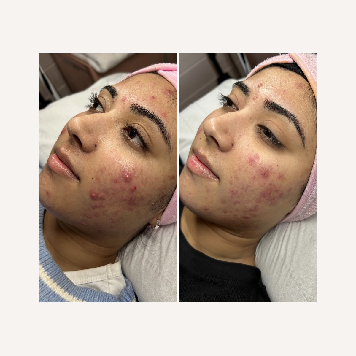 Real LA Skin Spa client result 10, shown without retouching
