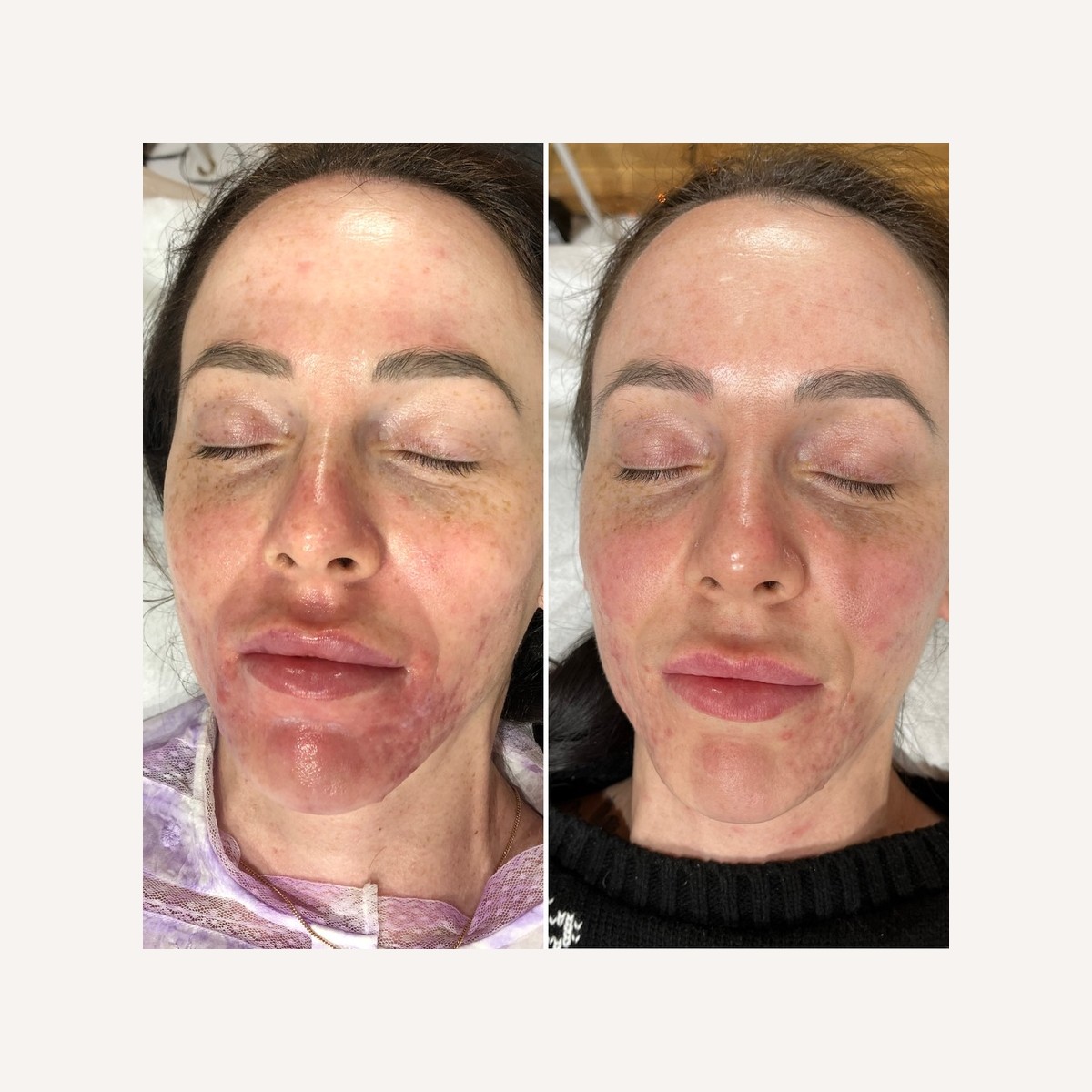 Real LA Skin Spa client result 11, shown without retouching