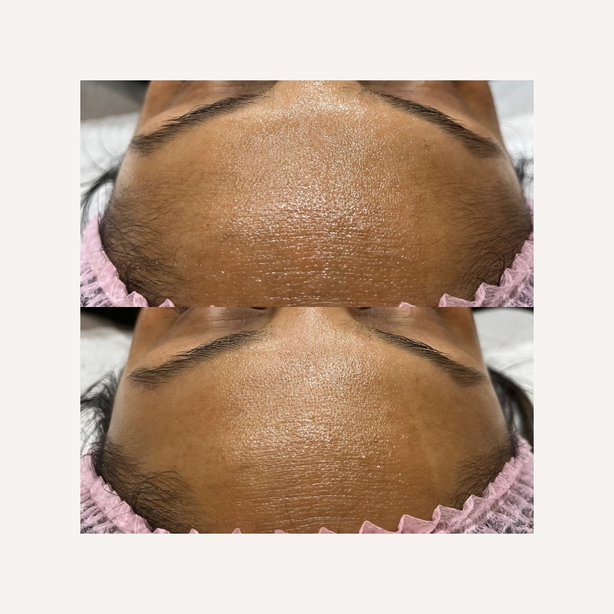 Real LA Skin Spa client result 12, shown without retouching