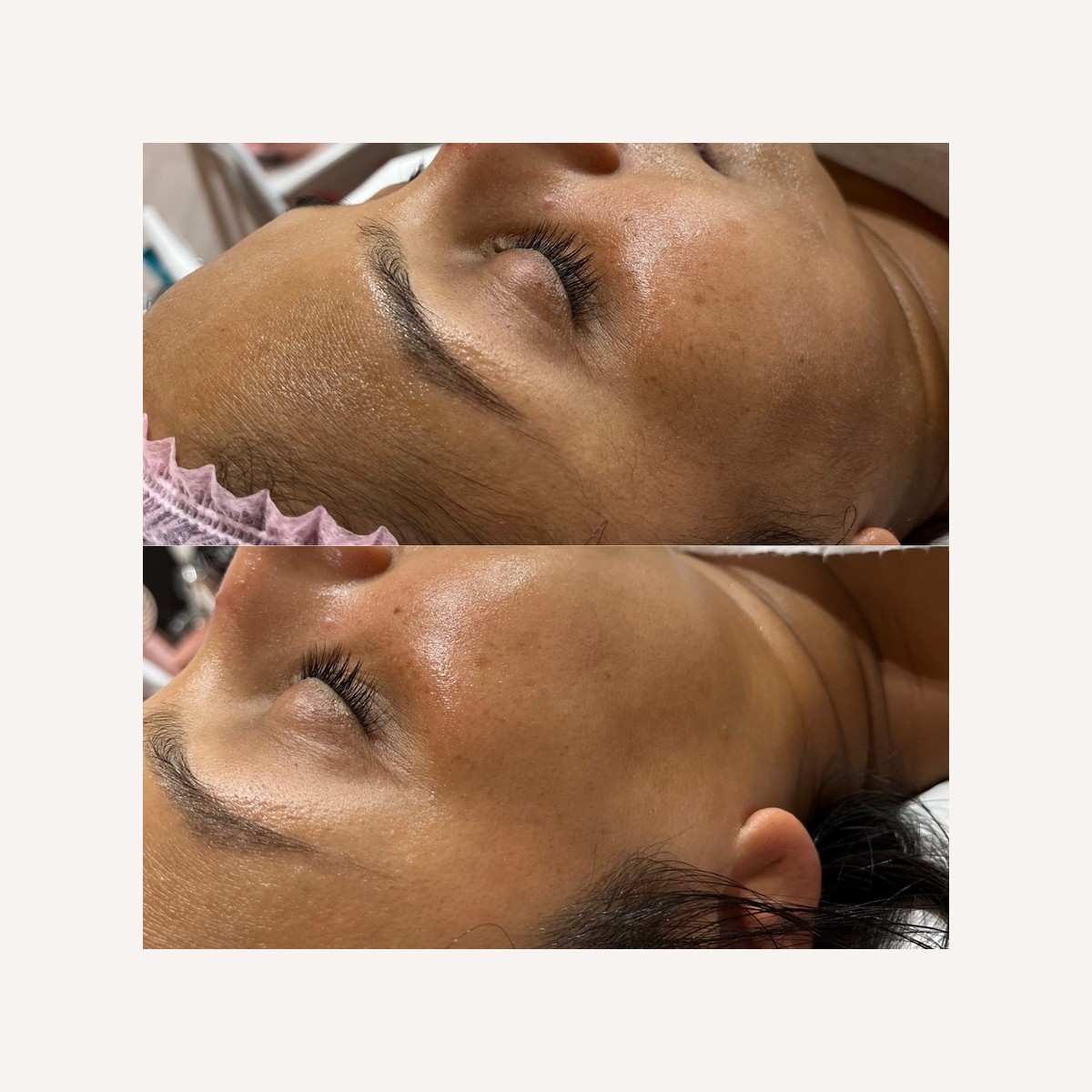 Real LA Skin Spa client result 13, shown without retouching