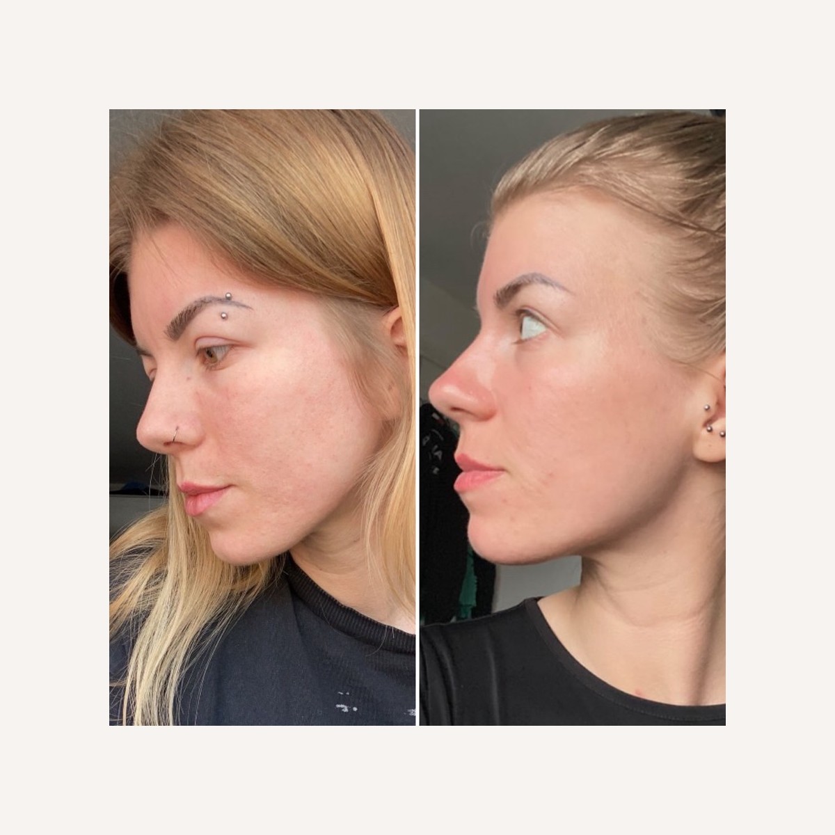 Real LA Skin Spa client result 15, shown without retouching