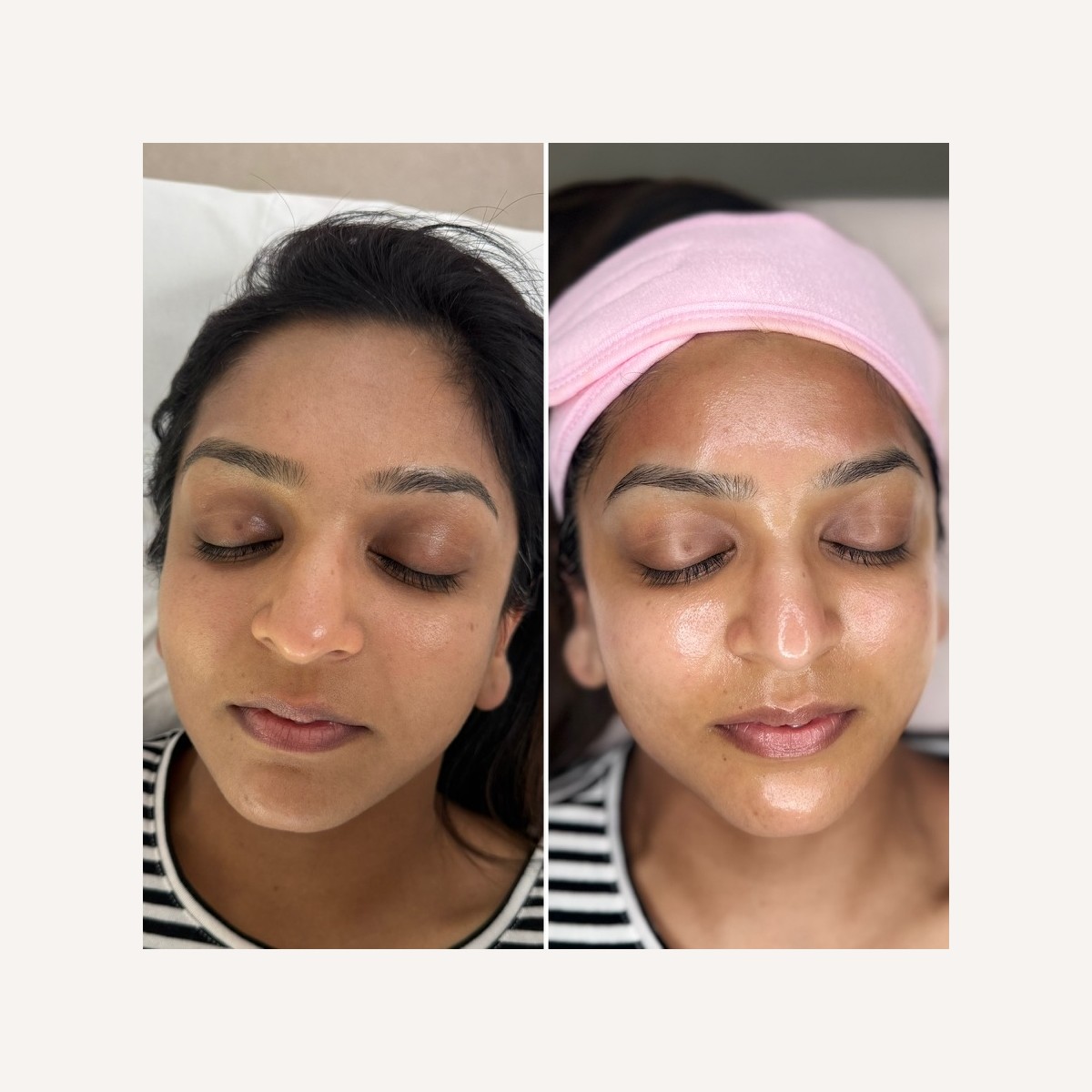 Real LA Skin Spa client result 16, shown without retouching
