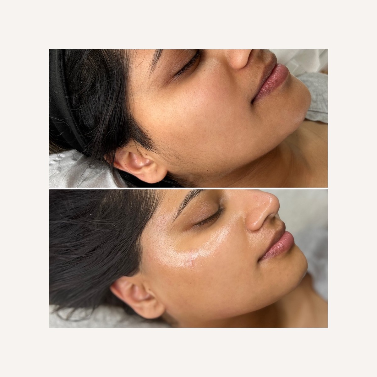 Real LA Skin Spa client result 17, shown without retouching