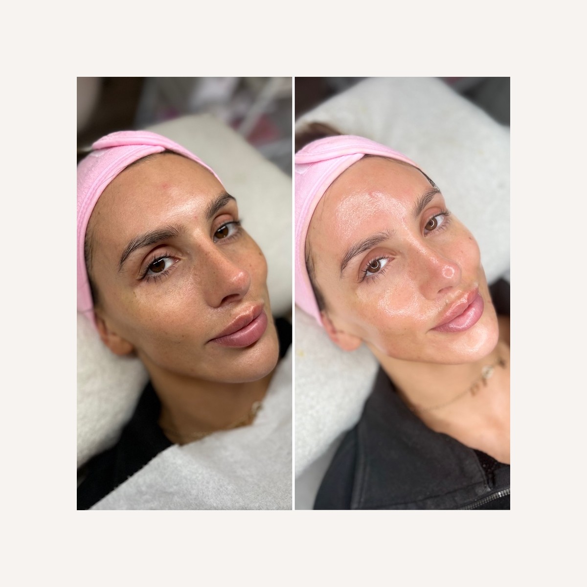 Real LA Skin Spa client result 18, shown without retouching