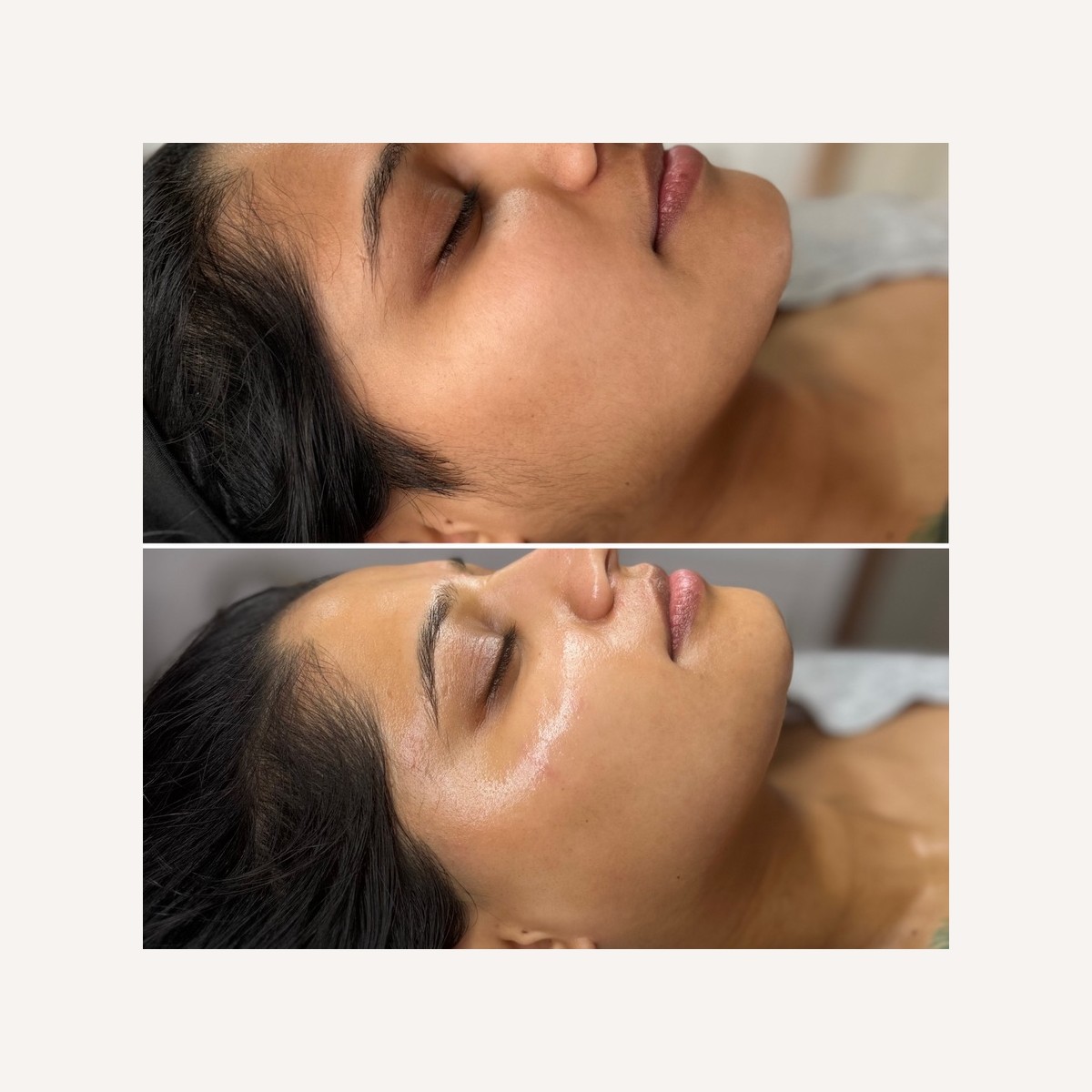 Real LA Skin Spa client result 19, shown without retouching