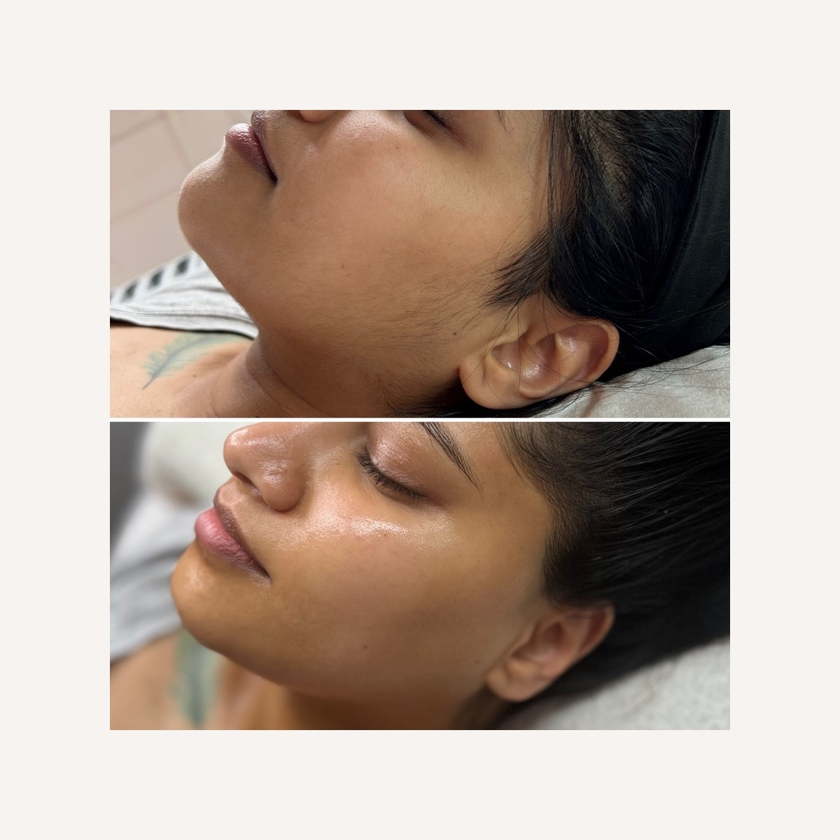 Real LA Skin Spa client result 20, shown without retouching