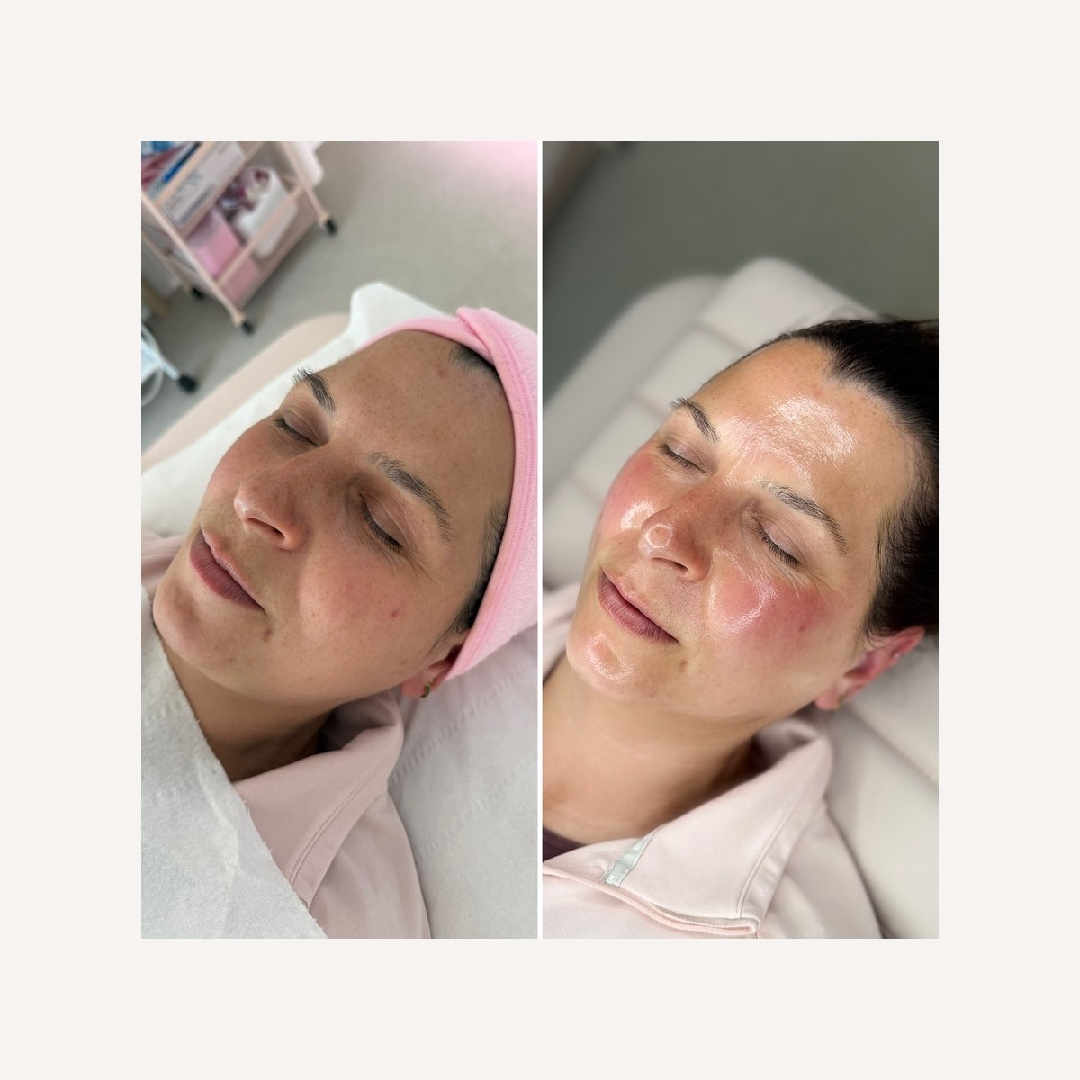 Real LA Skin Spa client result 21, shown without retouching