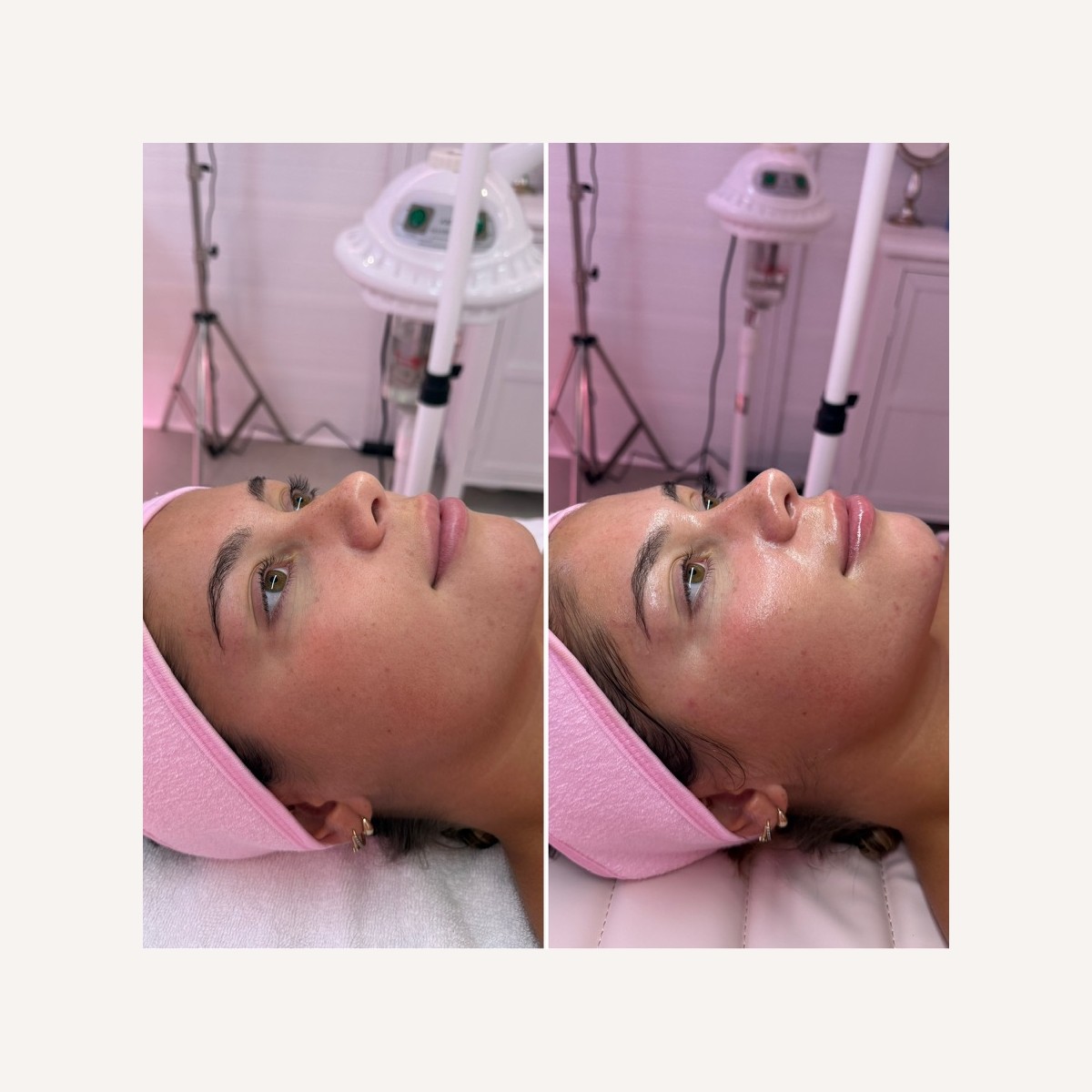 Real LA Skin Spa client result 22, shown without retouching