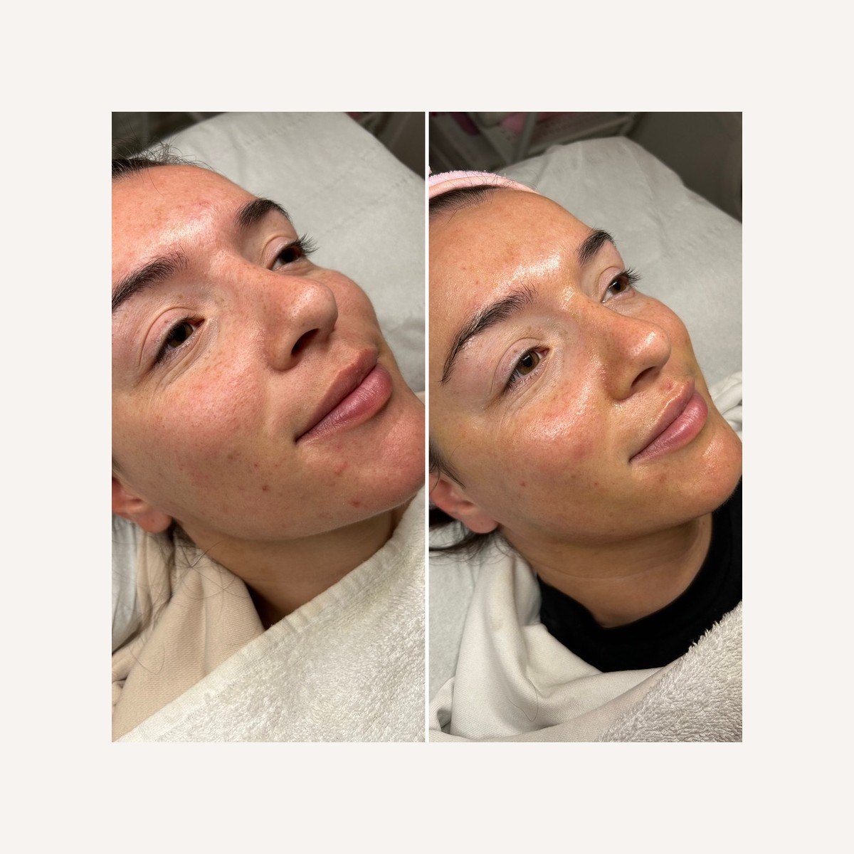 Real LA Skin Spa client result 23, shown without retouching