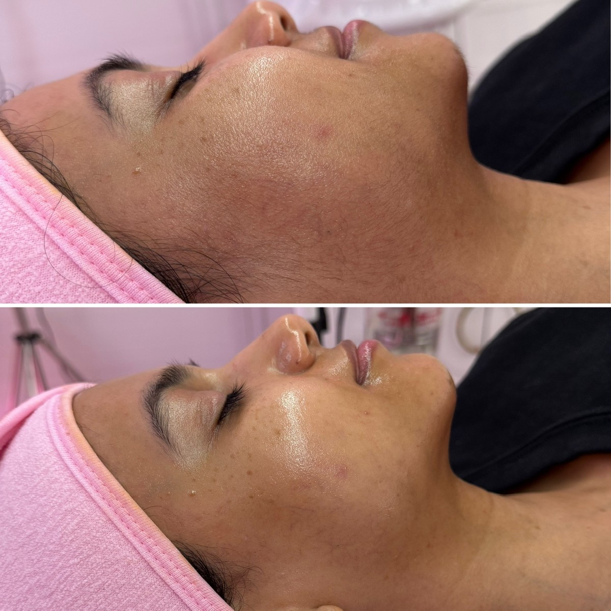 Real LA Skin Spa client result 24, shown without retouching