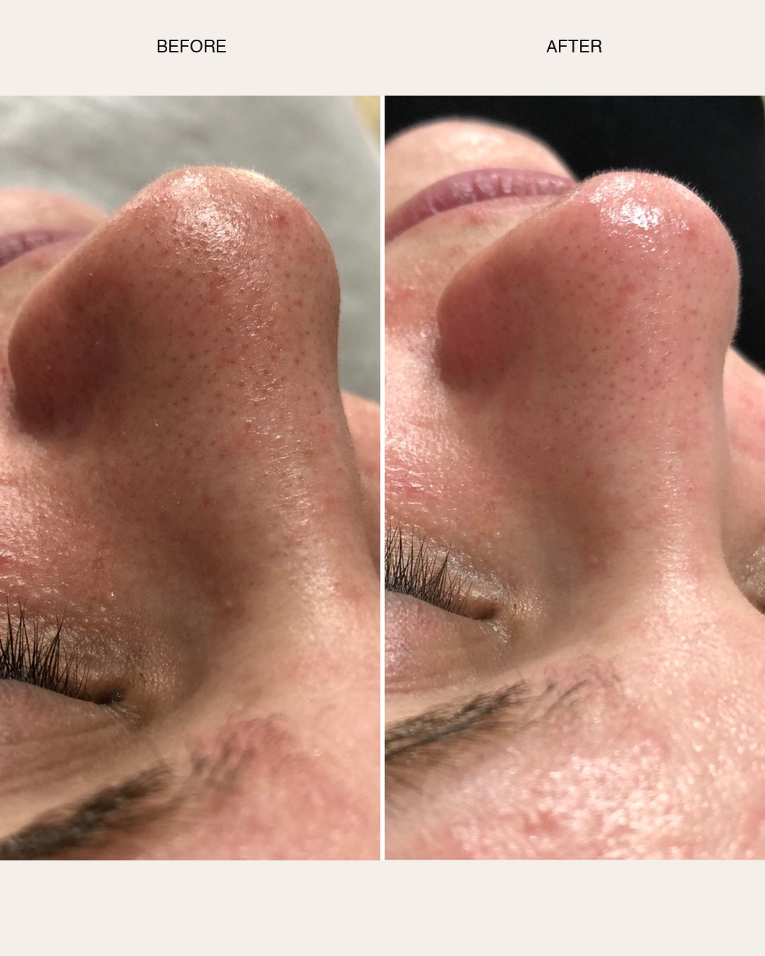 Before-and-after close-up showing reduced visible blackheads following a Blackhead Busting Facial
